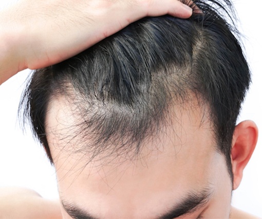 Hair Loss Treatment In Bhubaneswar
